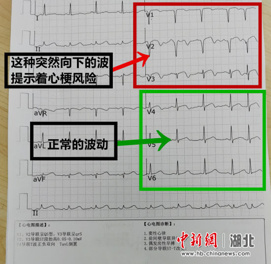 易师傅的心电图