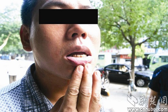 成浓盐酸+口腔被严重